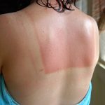 A woman with a sunburned back stands with a towel wrapped around her after a shower.