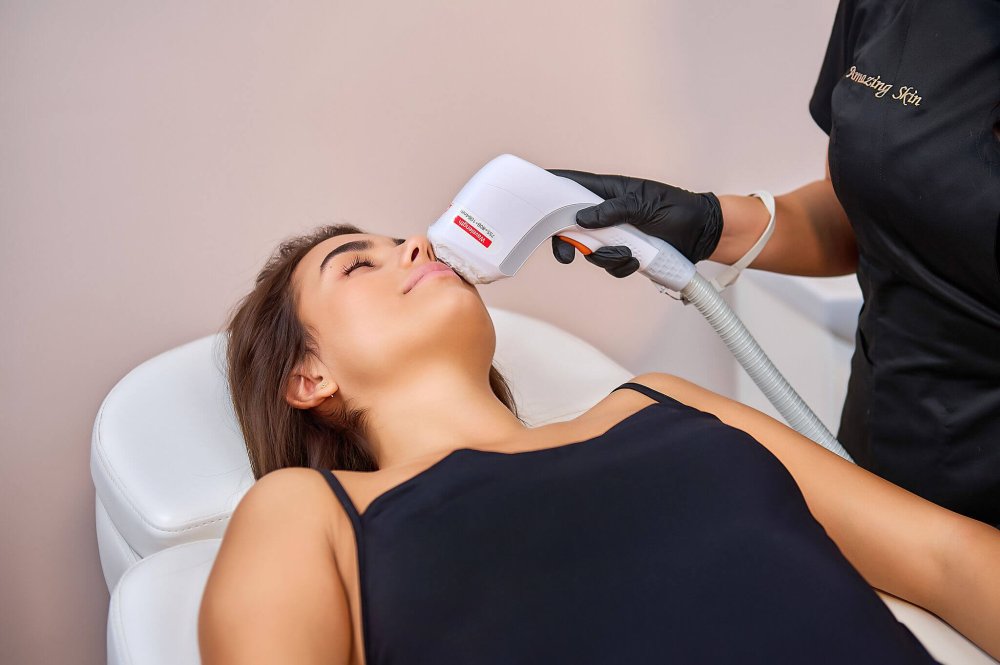 epilare faciala cu laser