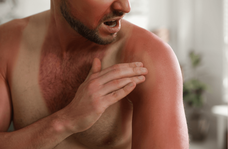 piele barbat expusa prea mult la soare