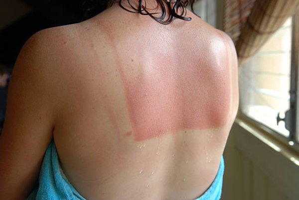 A woman with a sunburned back stands with a towel wrapped around her after a shower.
